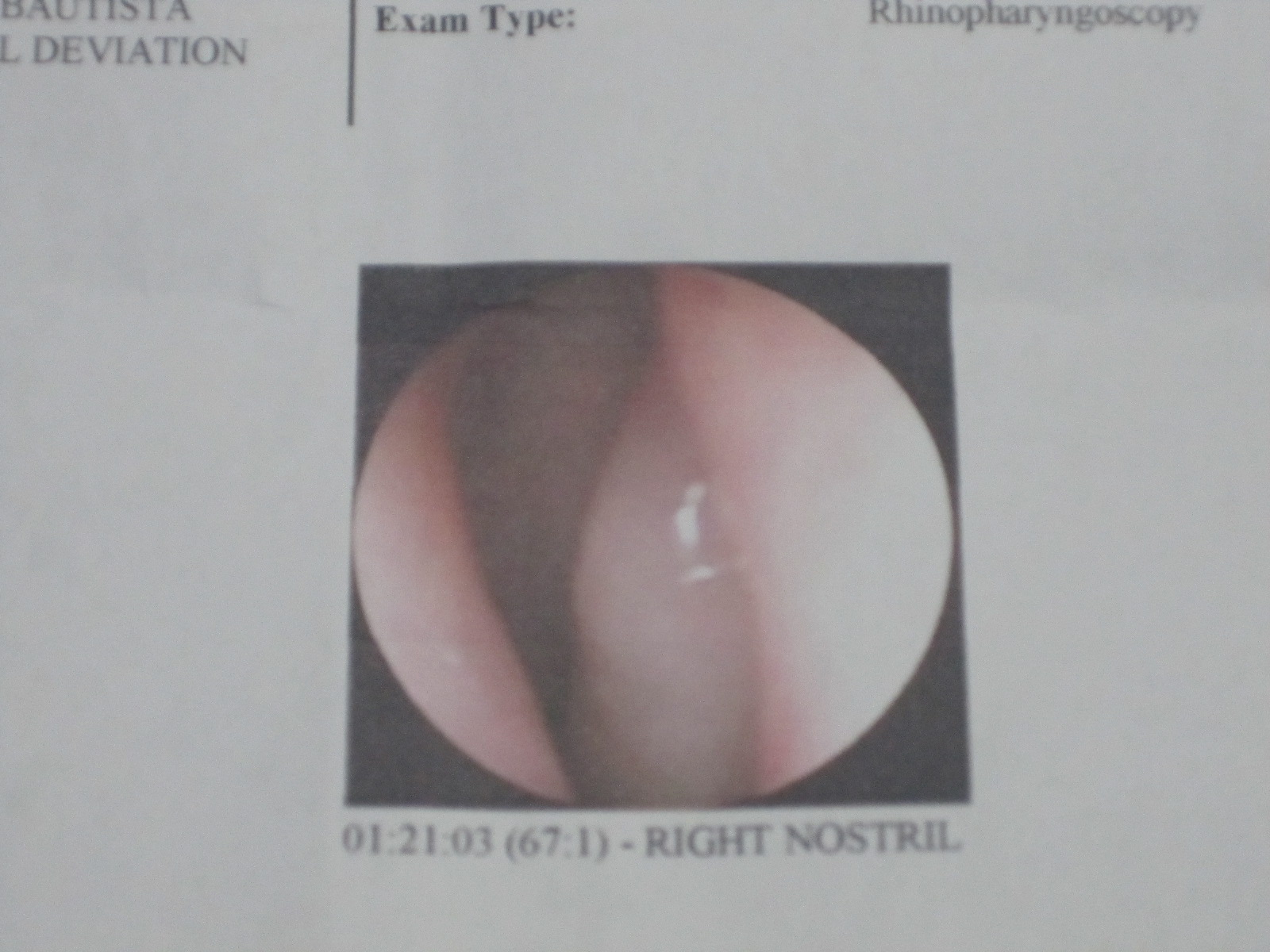 Nostril Inflammation